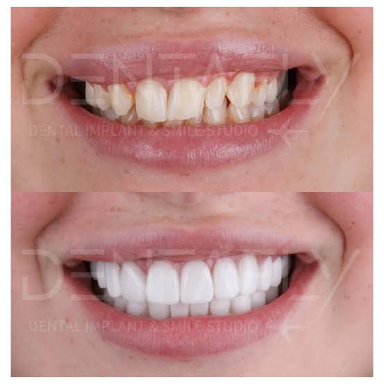 Dental Implants